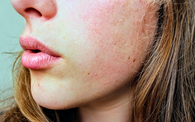 Les effets secondaires des traitements de la peau à base de rétinoïdes